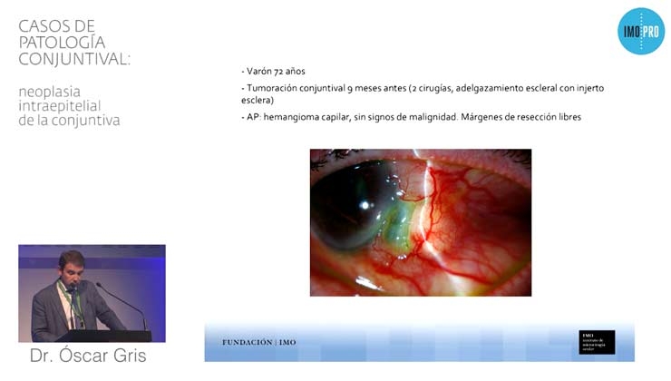 Casos de patología conjuntival: carcinoma escamoso