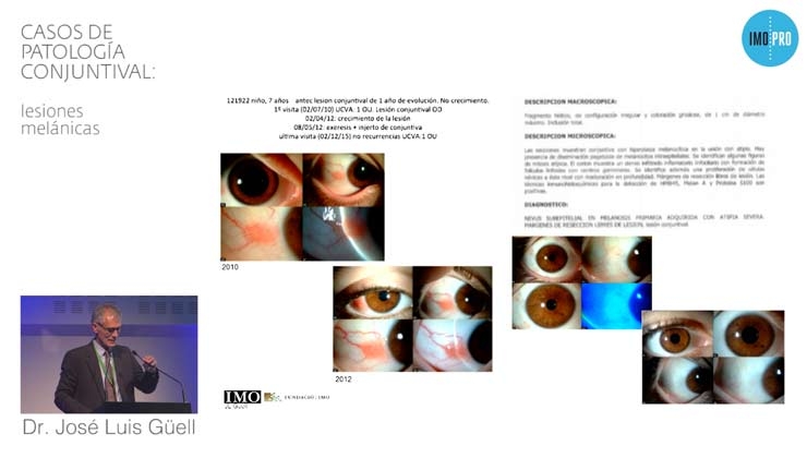 Casos de patología conjuntival: lesiones melánicas