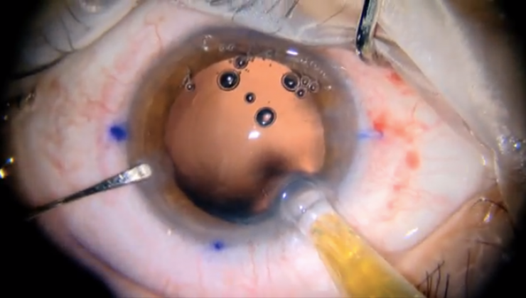 lente astigmatismo