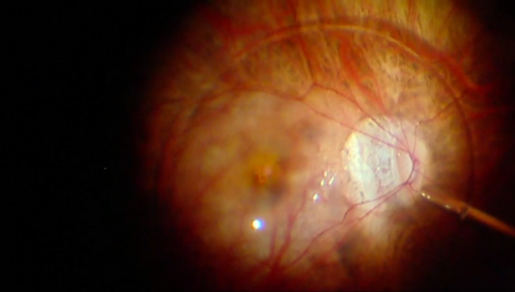 Dr. Mateo - Indentación macular