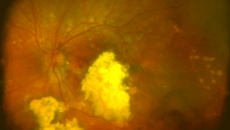 Origen del retinoblastoma infantil y consecuencias en la adultez