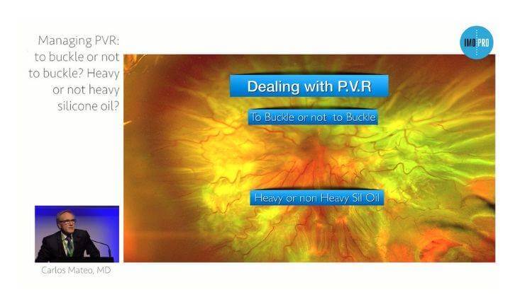 Managing PVR: to buckle or not to buckle? Heavy or not heavy silicon oil?