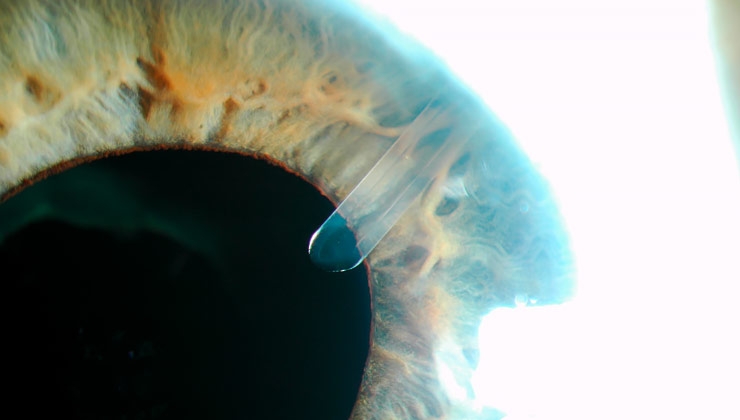 Máster en glaucoma