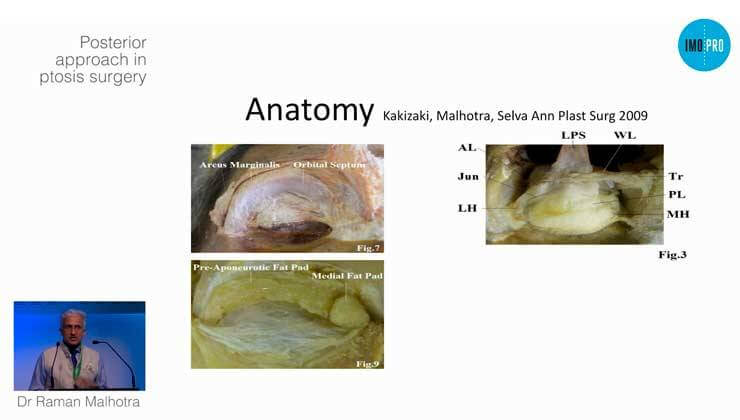 Posterior approach in ptosis surgery