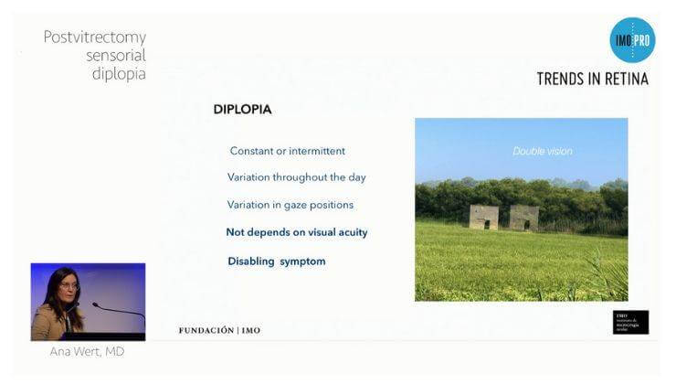  Postvitrectomy  diplopia